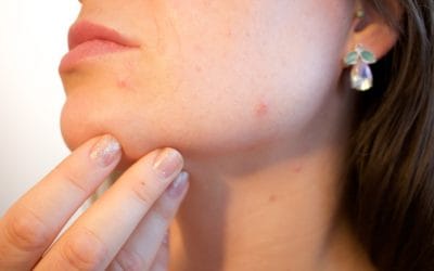 Cystic Acne – A Quick Understanding