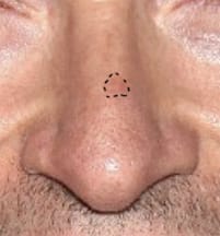Likely Contour of Hugh Jackman's Basal Cell Carcinoma in 2013