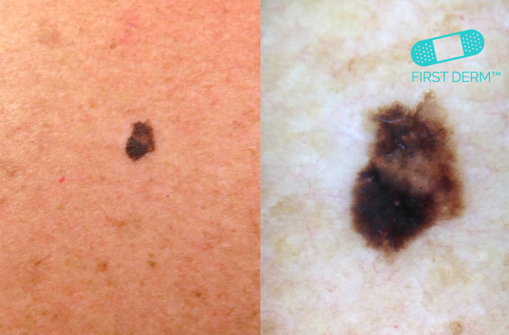 Føflekkreft! Hvordan du kan oppdage den tidlig dermatoskopi melanom