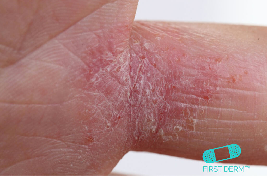 Itchy rash picture Atopic dermatitis finger ICD 10 L20.9