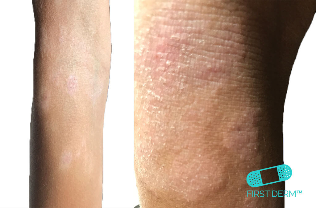 Itchy skin Atopic dermatitis eczema children arm ICD 10 L20.9