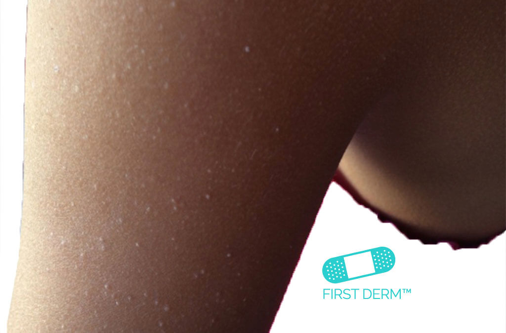 Keratosis pilaris tips from a dermatologist - Dr Dray