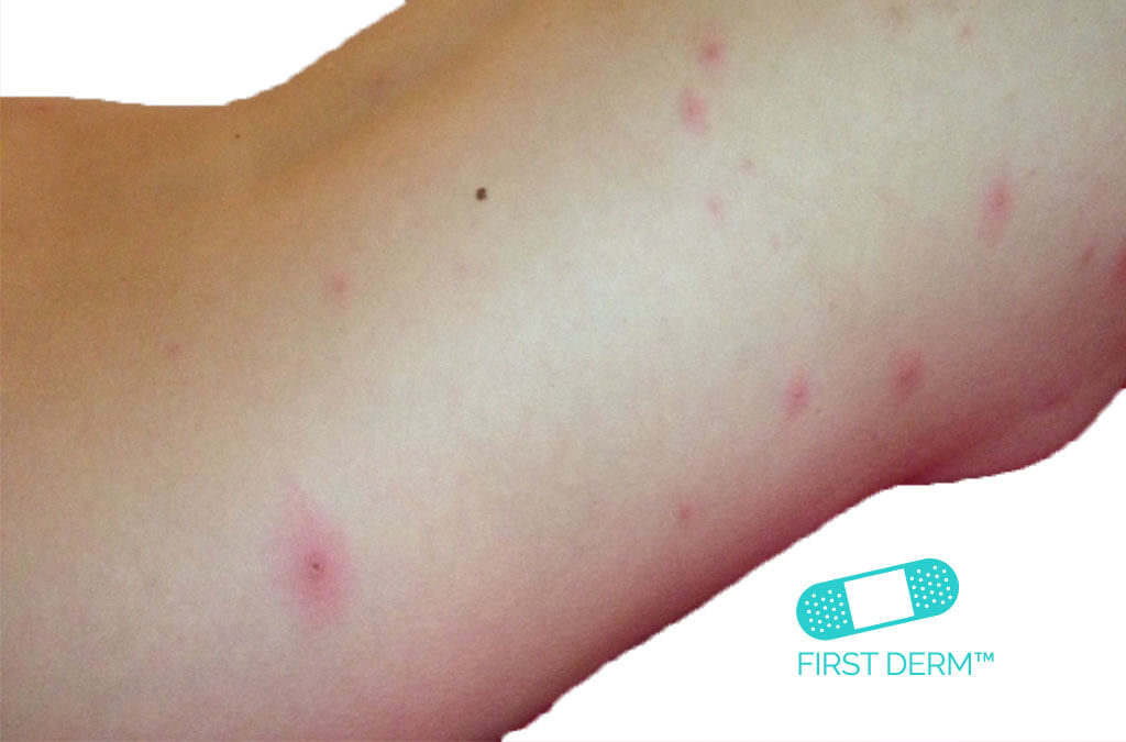 Rote Punkte auf der Haut: Bilder, Ursachen, Behandlung.