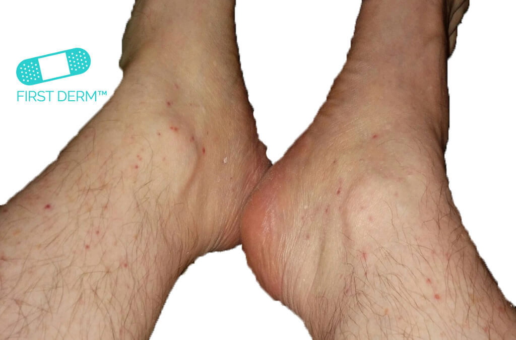 Red spots on skin LEUKOCYTOCLASTIC VASCULITIS on both legs ICD 10 L95.9