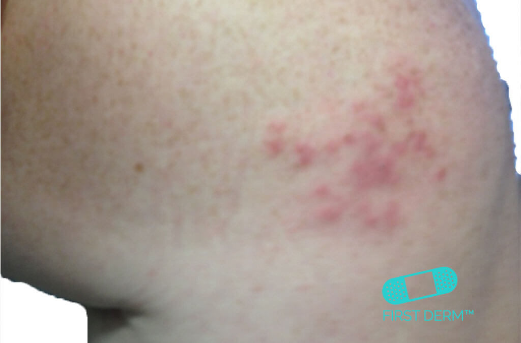 Red spots on skin Shingles herpes zoster on knee ICD 10 B02