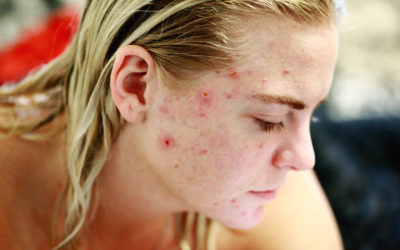Why Acne Tends To Worsen Every Summer?