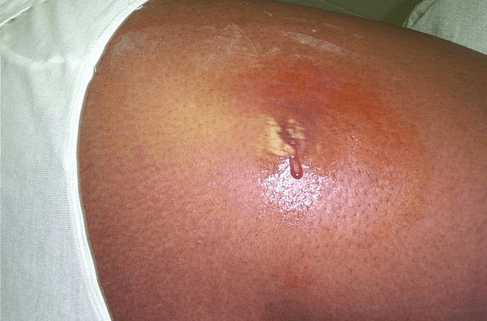 Close-up image of a 1cm wide skin abscess on the arm of a person with medium brown skin. The abscess is characterized by a distinct dark brown edge, surrounding a paler center where pus is visibly accumulated. The contrast between the inflamed skin and the pus-filled core highlights the typical appearance of a skin abscess