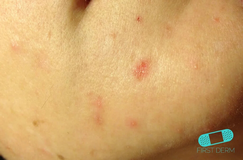 Person's face with Grade One acne vulgaris, characterized by flat, red macular scars. The skin shows several small, flat red marks, indicative of mild acne scarring without significant raised or pitted areas