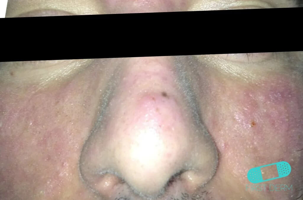 Image of a person's face affected by acne vulgaris, showing numerous blackheads. These blackheads are open comedones visible at the surface of the skin, filled with excess oil and dead skin cells, giving them a distinctive black appearance due to the irregular light reflection from the clogged hair follicles.