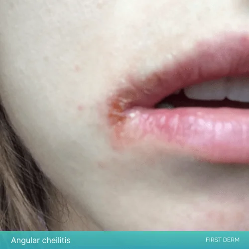 Close-up image of inflamed corners of the mouth indicating how to identify Angular Cheilitis, a common skin condition
