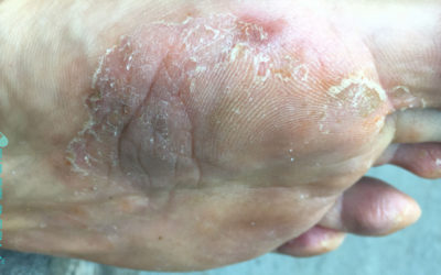 Tinea infections