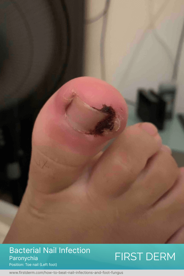 finger nail displaying signs of Paronychia, a nail infection characterized by redness, swelling, and tenderness. The infection is visible as a red bump on the side of the nail