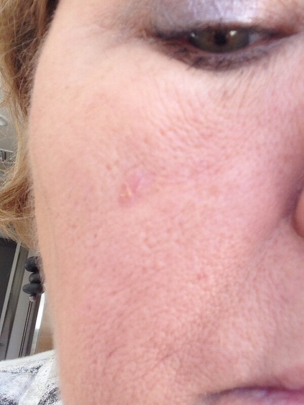 Basal cell carcinoma picture (basalioma) high quality image face