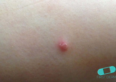 Basal cell carcinoma (Basal cell skin cancer, BCC) (01) arm [ICD-10 C44.91]