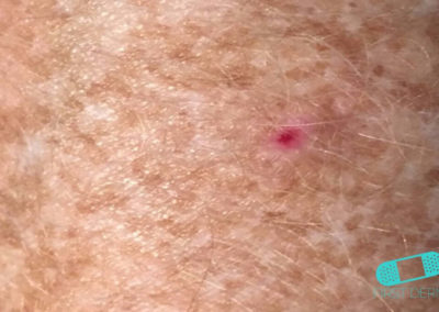 Basal cell carcinoma (Basal cell skin cancer, BCC) (02) chest [ICD-10 C44.91]