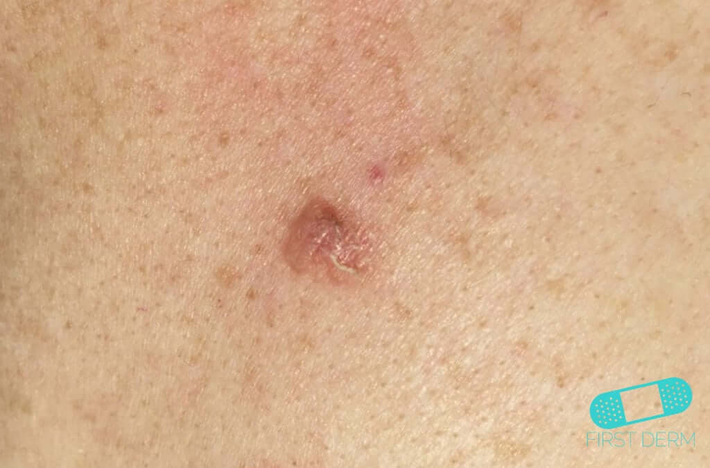 Basal cell carcinoma (Basal cell skin cancer, BCC) (08) breast [ICD-10 C44.91]