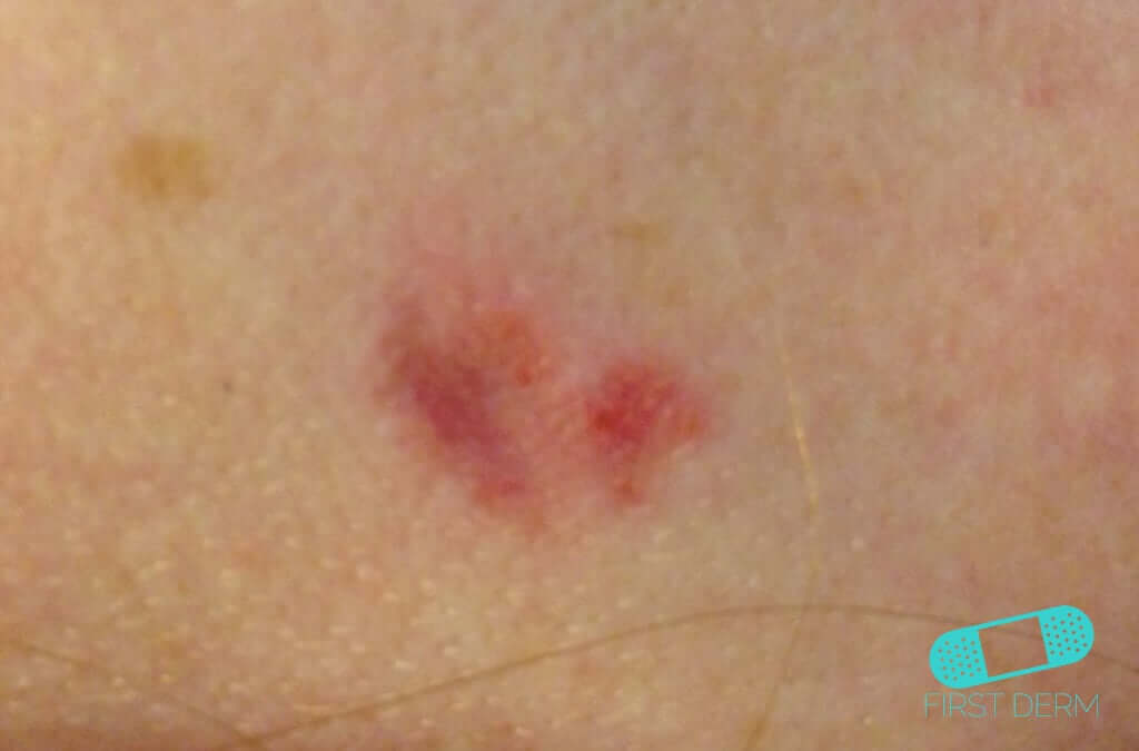Basal cell carcinoma (basalioma) pictures back high quality image ICD 10 C43.9