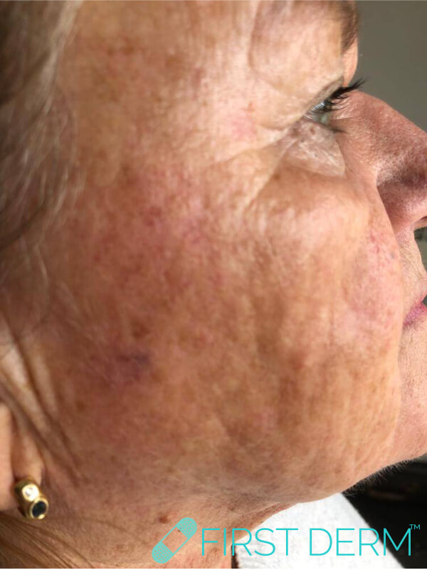 Best Senile warts (Seborrheic Keratosis) treatment face after close up
