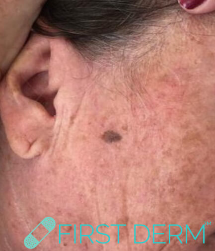 Best Senile warts (Seborrheic Keratosis) treatment face close up before