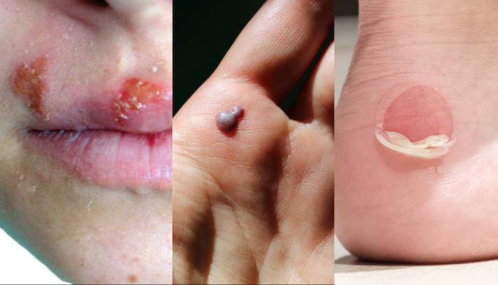 blisters-pop-or-not