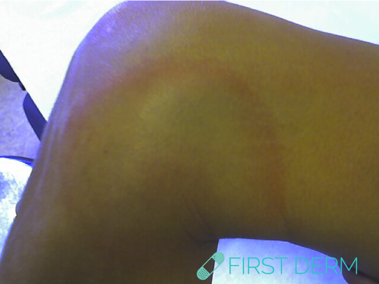 Lyme disease rash Borrelia Knee ICD10 A69.2