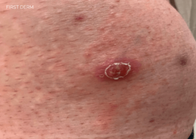 Early stage carbuncle image: reddish bump on skin with surrounding redness and swelling