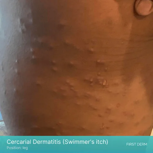 Cercarial dermatitis rash with papules and swelling on the leg
