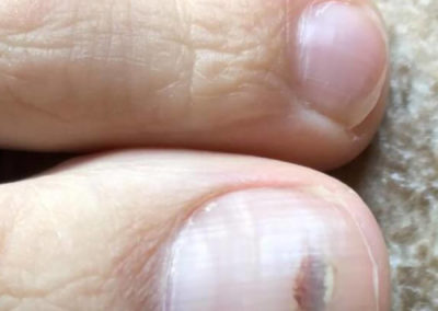 Common nail discoloration Subungual Hematoma (Blood Under Nail)