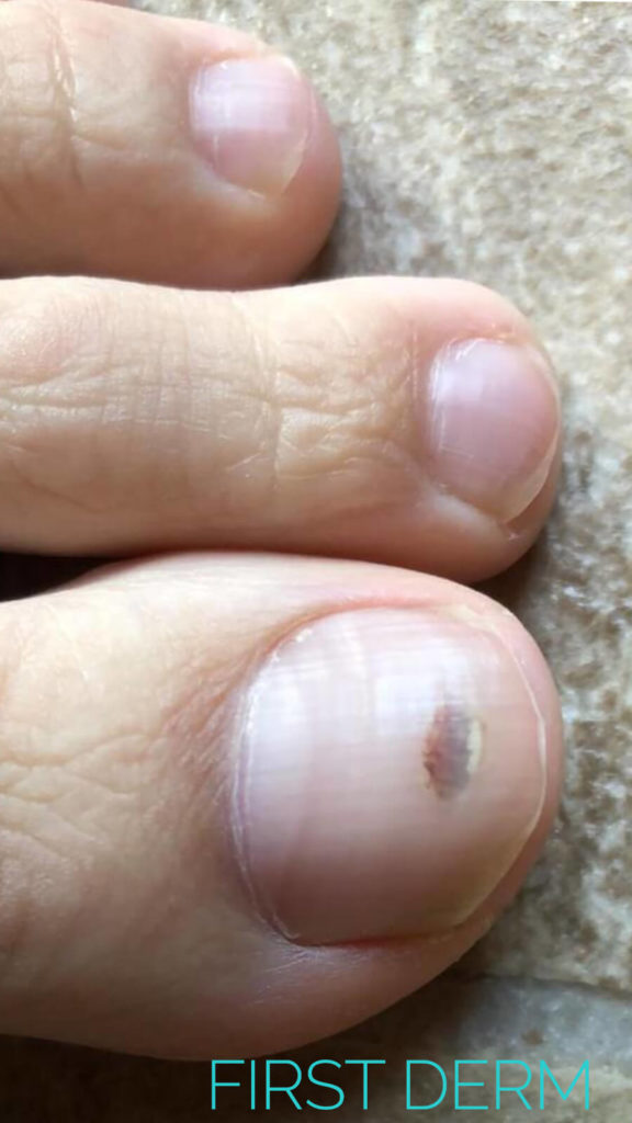How to remove dried blood under my fingernail - Quora