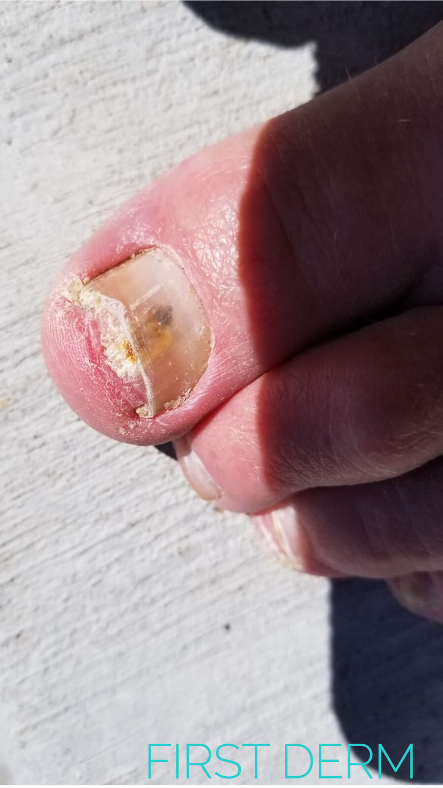 Hangnail: Causes, Symptoms, and Treatment