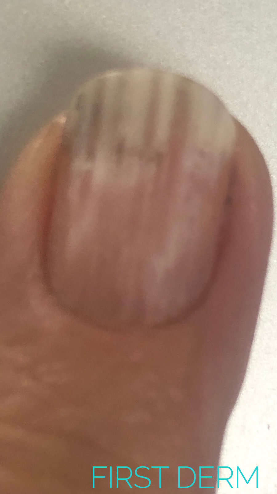 Common nail discoloration leukonychia