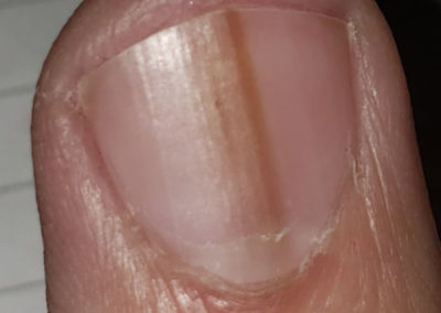 Common nail discoloration melanonychia