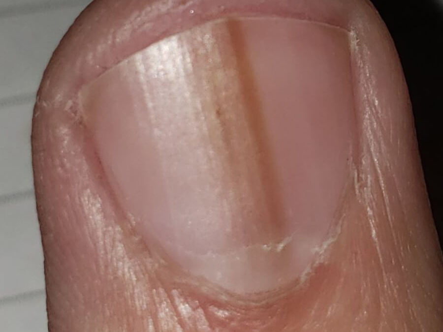Common nail discoloration