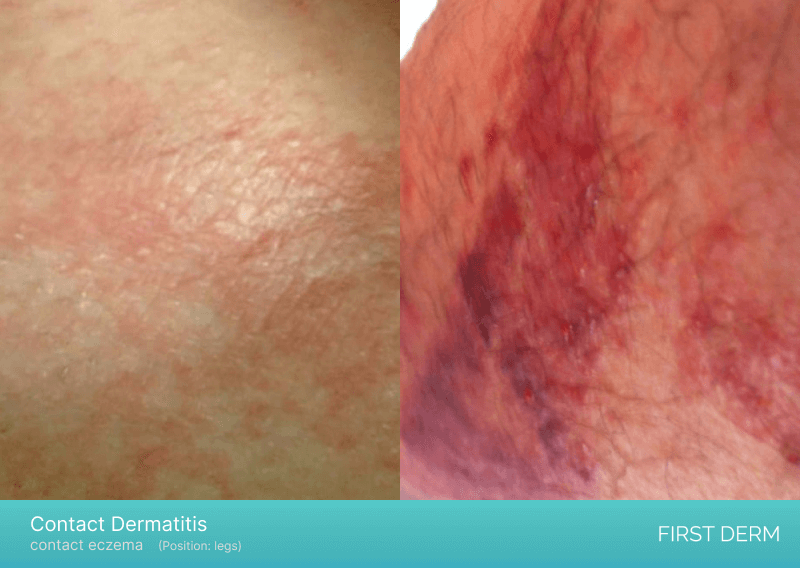 A combination of two photos showcasing contact dermatitis on a person's leg. The photo on the left displays irritative eczema with slight reddishness, while the photo on the right showcases red spots on the skin caused by plants.