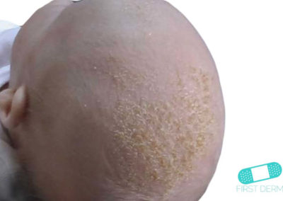 Costra Láctea (Dermatitis Seborreica) (01) cabeza bebé [ICD-10 L21.0]