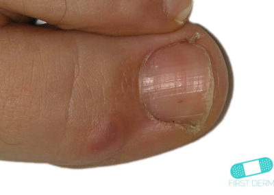 Quistes digitales mixoides (01) dedo del pie [ICD-10 M71.349]