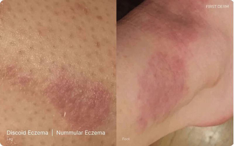 Discoid Eczema, also known as Nummular Eczema, on a leg. Characterized by round or oval patches of inflamed, itchy, and scaly skin