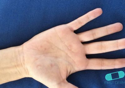 Dyshidrotiskt eksem (11) hand [ICD-10 L30.1]