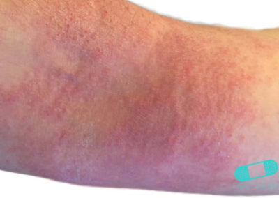 Eczema Atópico (04) brazo [ICD-10 L20.9]