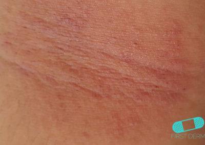 Eczema Atópico (05) piel [ICD-10 L20.9]