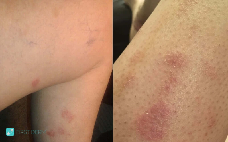 Nummular Eczema involved with mind body connection appearing in leg