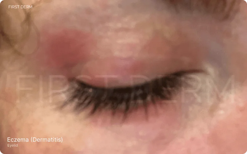 Close-up image showing eyelids affected by dermatitis, commonly known as eczema, featuring distinct reddish patches and signs of skin inflammation and irritation