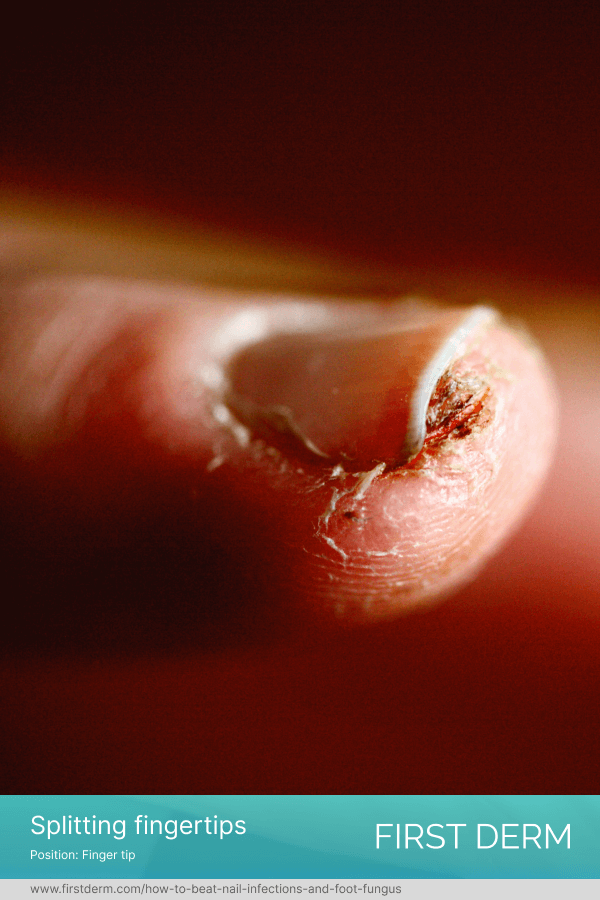 condition of fingertip splitting, caused by dryness and lack of elasticity in the skin