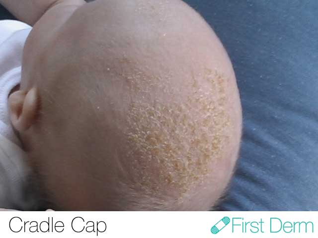 Cradle Cap Newborn Toddler Seborrhoeic-Dermatitis ICD-10 L21.0
