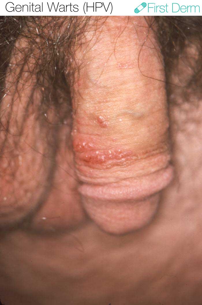 Genital Warts (04) HPV (human papillomavirus) penis [ICD-10 A63.0]