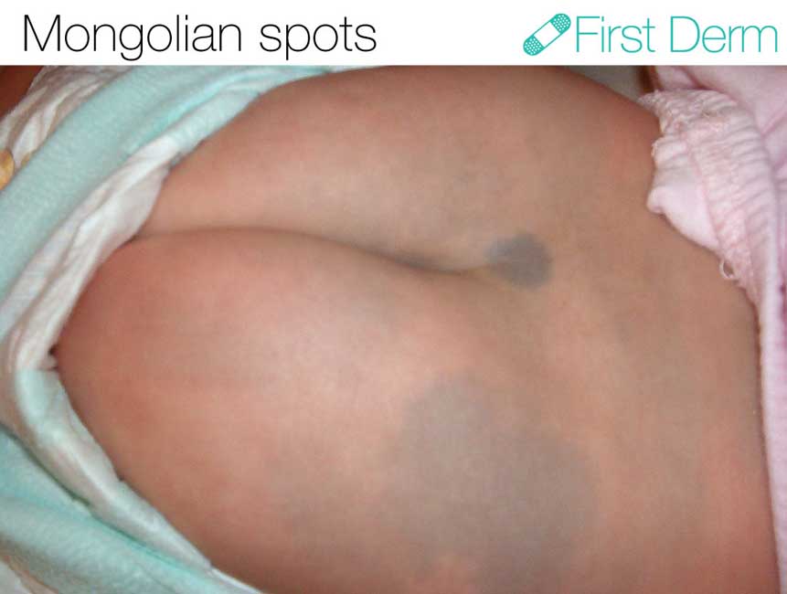 Mongolian-Spot-buttocks ICD-10-D22