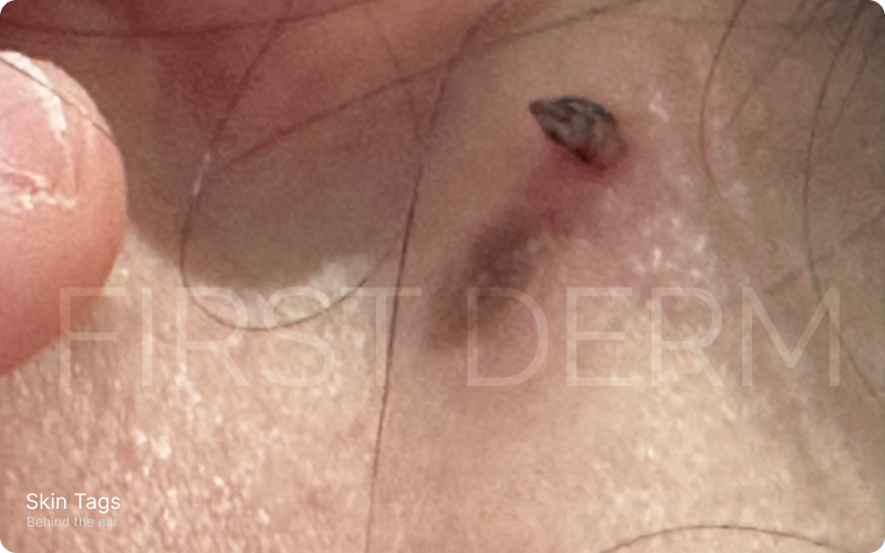Close-up image of the neck area behind the ear featuring a skin-colored, soft, non-itchy raised bump known as a skin tag. Common in adults and often found in skin folds, its size ranges from a few millimeters to 1 centimeter. 