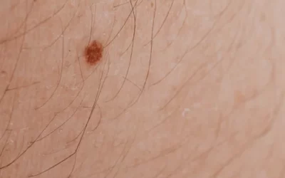 Non-melanoma skin cancer killing more people than melanoma, new study finds