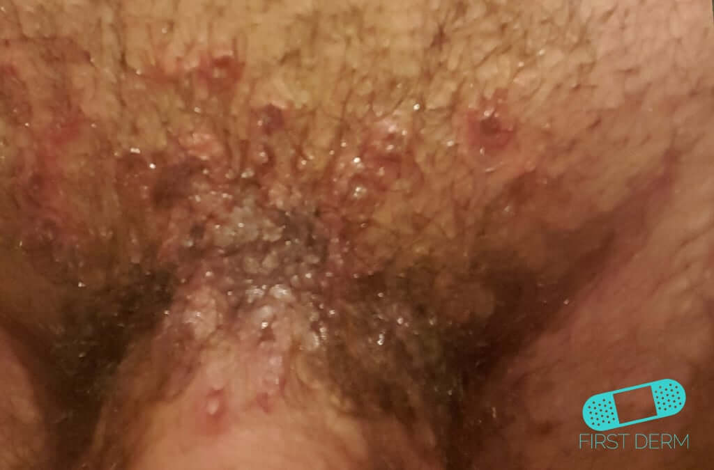 Picture of Genital Herpes symptoms on pubic region [ICD-10 A60.0]