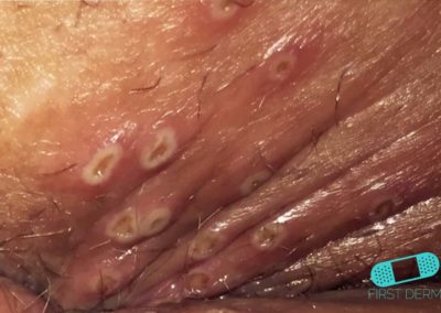 Genital Herpes (13) sår vagina [ICD-10 A60.0]